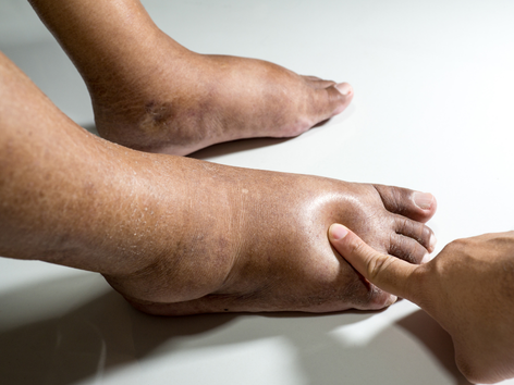 7 Science-Backed Ways How to Get Rid of Fluid Retention That Actually Work (Even If You’ve Tried Everything)